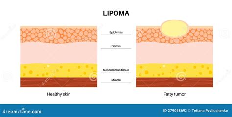 Lipoma Medical Poster Cartoon Vector | CartoonDealer.com #279576719