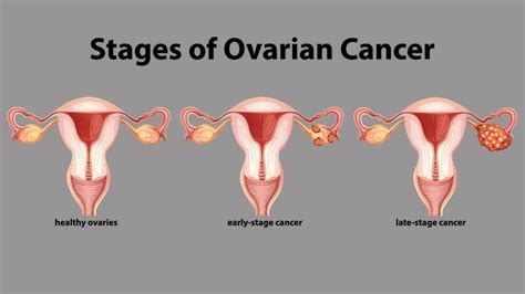 Checkup for Ovarian Cyst Removal Surgery and Treatment