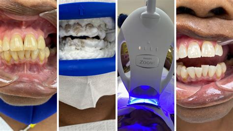 The Zoom Teeth Whitening Experience: Cost, Procedure, and Pain