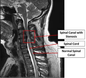 Spinal Stenosis Treatment - New Jersey - Centers for Neurosurgery ...