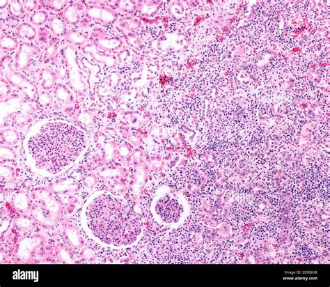 Renal cortex affected by a chronic pyelonephritis. The renal parenchyma ...