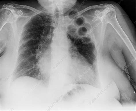 Plombage tuberculosis treatment, X-ray - Stock Image - C038/6695 - Science Photo Library