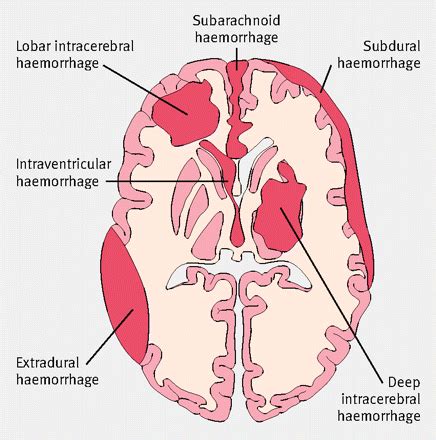 Spontaneous intracerebral haemorrhage | The BMJ