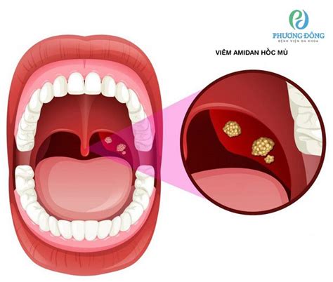 Viêm amidan mãn tính là gì, triệu chứng và cách điều trị