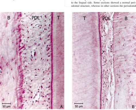 (A) Photomicrograph showing the stretched fibers of the PDL of a second ...