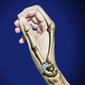 Treating Basal Joint Oseoarthritis in Plano, Frisco, McKinney and Allen Plano Orthopedic Sports ...