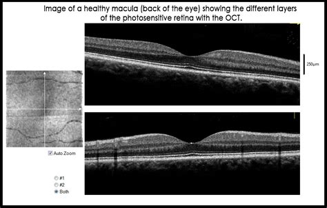 Normal Macula - Charl Laas Optometrists