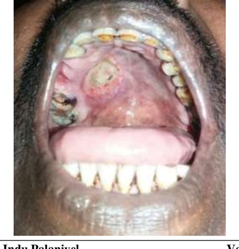 Figure 2 from Surgical Management of Necrotizing Sialometaplasia of ...