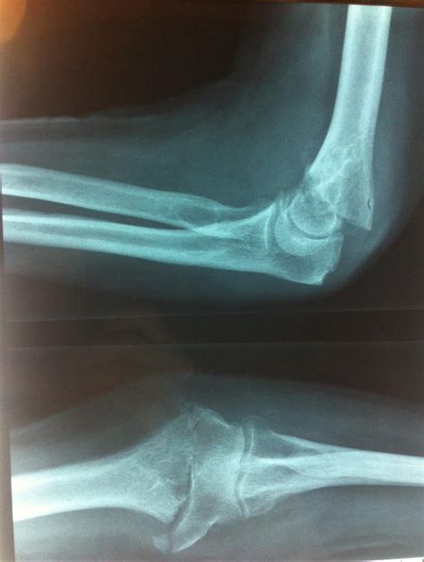 Distal Humerus Fractures - Trauma - Orthobullets