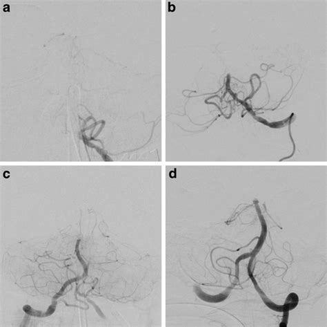 Classification of basilar artery occlusion location. Type I are ...