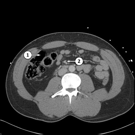 CT abdomen/pelvis (lower) axial - labelling questions | Radiology Case ...