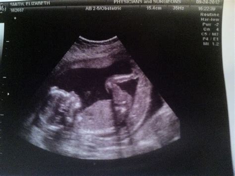 Out of the Blue: 17 Week Update and Anatomy Ultrasound