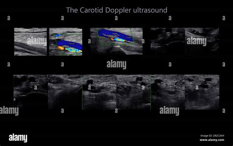 A carotid artery Doppler ultrasound is a diagnostic test used to check the arteries in the neck ...