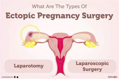 Ectopic Pregnancy Surgery: Purpose, Procedure, Benefits and Side Effects