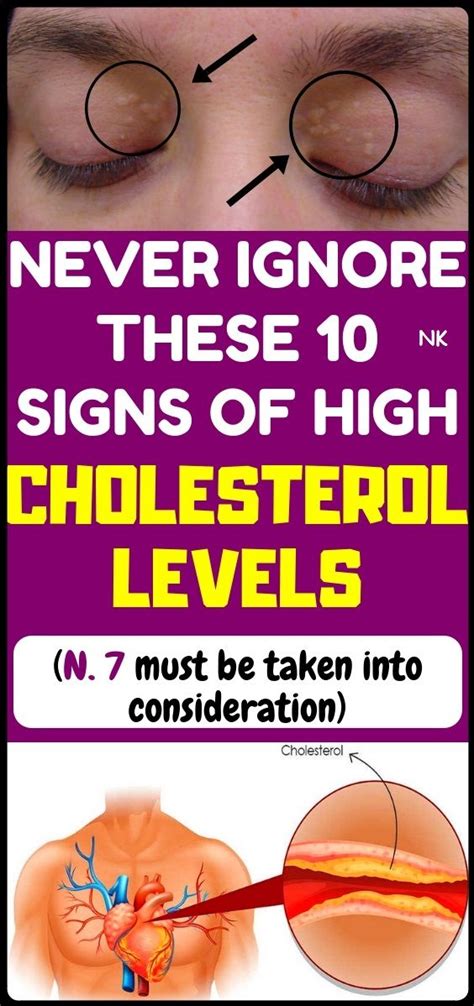 10 Symptoms Of High Cholesterol That You Shouldn’t Ignore | High cholesterol, Cholesterol