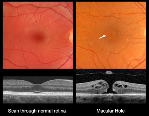 Macular Hole I Mr Ellabban Eye Surgery | Yorkshire & Hull