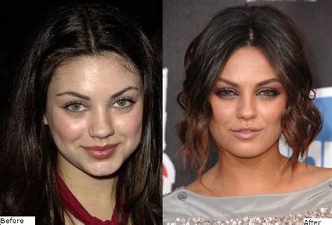 Mila Kunis Plastic Surgery