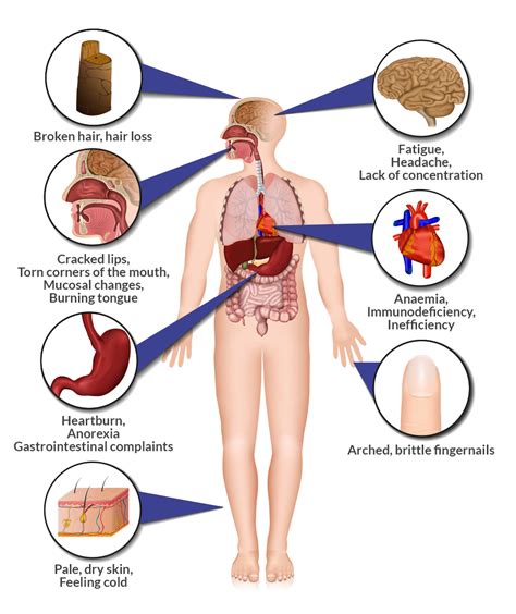 Iron Deficiency Anaemia | CFCH | Centre for Clinical Haematology