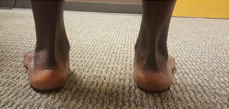 Figure 1 from Treatment of Chronic and Severe Pes Planovalgus Deformity using Sym align ® Evans ...