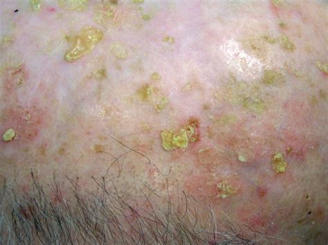 Actinic Keratosis Pictures and Photos