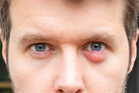 Bump Under Eyelid: Skin Cancer or Chalazion Cyst? » Scary Symptoms
