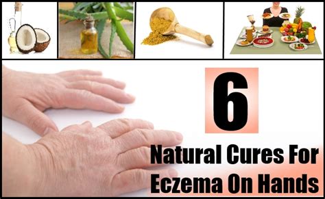 6 Natural Cures For Eczema On Hands – Natural Home Remedies & Supplements