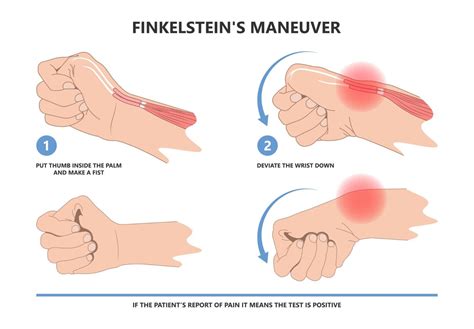 Tenosynovitis: What Is It, De Quervain's Tenosynovitis,, 56% OFF