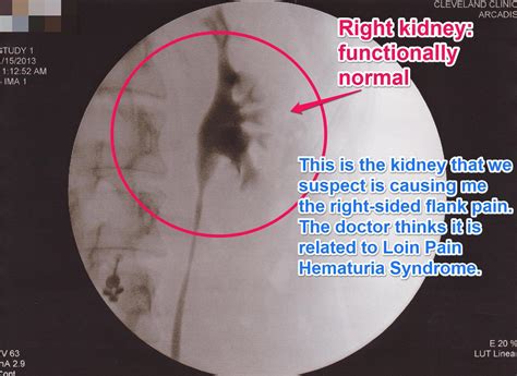 Loin pain hematuria syndrome