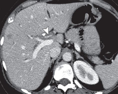 IgG4-related Sclerosing Disease: Autoimmune Pancreatitis and Extrapancreatic Manifestations ...