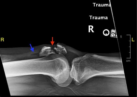 Open Fracture of the Patella - JETem