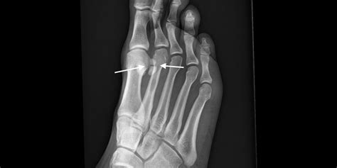 Sesamoid Bone Fracture