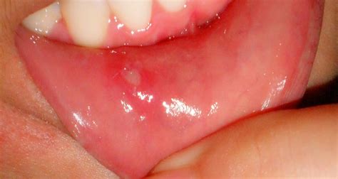 Aphtous ulcer and herpes (mouth wounds) | Dentince