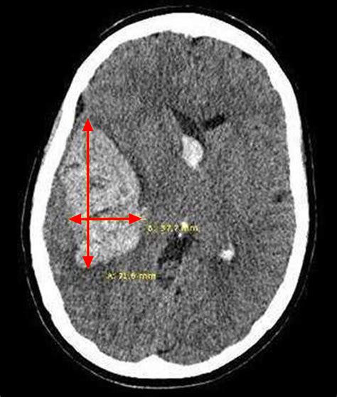 Intracranial Hemorrhage - Cause, Symptoms, Diagnosis, Treatment