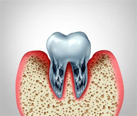 Periodontal scaling and root planing | Fine Quality Dental