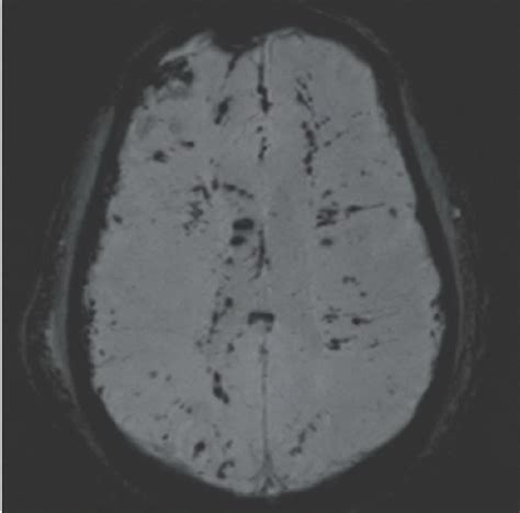 Diffuse Axonal Injury | Radiology Key