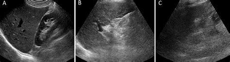 Illustration of ultrasound (US) LI-RADS visualization scores in... | Download Scientific Diagram