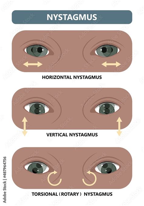 miosis eye pupil size iris retina brain Horner miotic muscle dilated ocular injury ptosis reflex ...