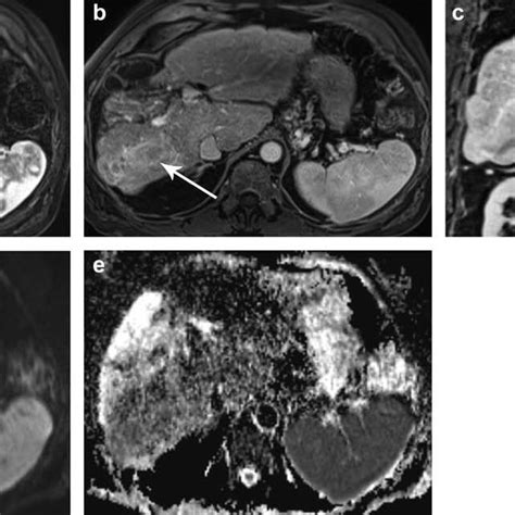 v2017 LI-RADS Treatment Response Algorithm. Reprinted with permission... | Download Scientific ...