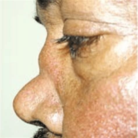 Saddle Nose Deformity Image – The Clinical Problem Solvers