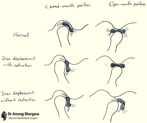 TMJ Disc Dislocation With & Without Reduction - Symptoms & Treatment - Dr Anurag Bhargava