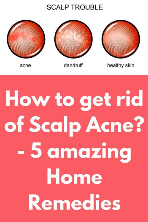 How to get rid of Scalp Acne?- 5 amazing Home Remedies Tired of the constant itching on your ...