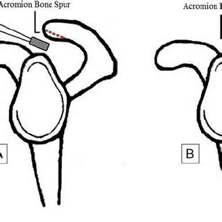 (PDF) Is Acromioplasty of Benefit for Rotator Cuff Repair?