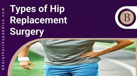 Types of Hip Replacement Surgery | 100% Best Treatment