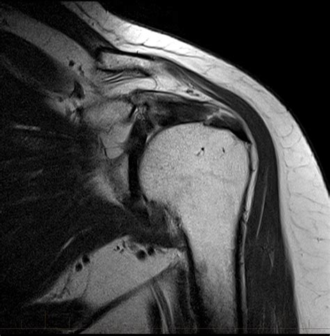 mri-shoulder-supraspinatus-tendon-tear-8 - MRI at Melbourne Radiology Clinic