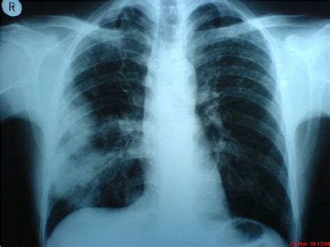 The initial pulmonary radiograph shows an infiltrate in the right lung ...