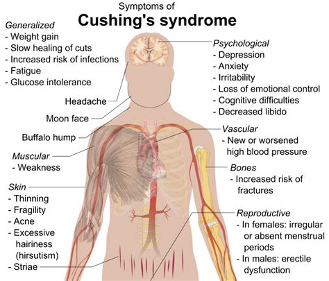 WHAT IS CUSHING’S SYNDROME | Strive For Good Health