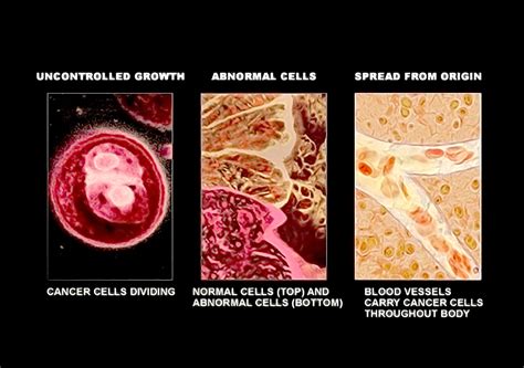 Cancer Cell Vs Normal Cell Microscope