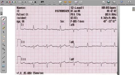 ECG 12 Lead Axis Deviation - YouTube