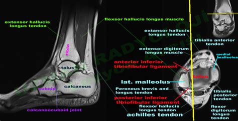 Foot Muscles Mri / Ankle And Foot Radiology Key - There are 10 ...