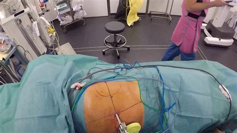 Docking Tips for Robot assisted partial nephrectomy with the X system ...